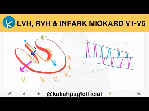 Video: Hipertrofi Ventrikular Kanan: Gejala, Punca, Diagnosis, Rawatan