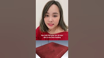 [ Kinh Nghiệm Cấy Tóc #16 ] Update ngày 16 cấy tóc. Bác sĩ cấy tóc cho mình như thế nào?