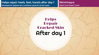 SkinIntegra - How our Rapid Crack Repair Cream Works SkinIntegra - How our Rapid Crack Repair Cream Works