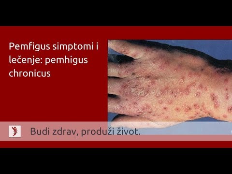 Pemfigus simptomi i lečenje: pemhigus chronicus