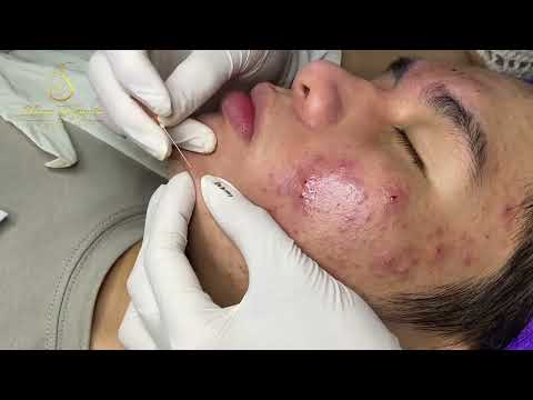 Loan Nguyen Acne Treatment 15099