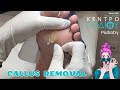 Callus removal|Αφαίρεση κάλου|Κέντρο Ποδιού Podiatry|Podiatrist|Podologos|Ποδιατρική|Ποδολογία|Πόδια