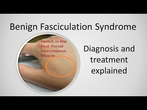 Benign Fasciculation Syndrome Causes and Treatment