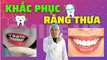 Dán răng Veneer khắc phục tình trạng răng thưa | Nha khoa Smile HT