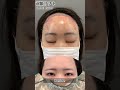 気になるダウンタイム経過👀#前額リフト #額リフト #美容整形
