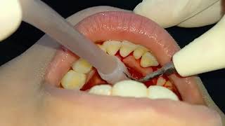 شاهد السبب الرئيسي في نزيف اللثه ورائحة الفم الكريهةdr_abdullah_sultan_dentist dentist 소아치과 orth