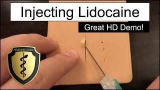 Injecting Lidocaine for a Laceration - HD Video Demonstration!