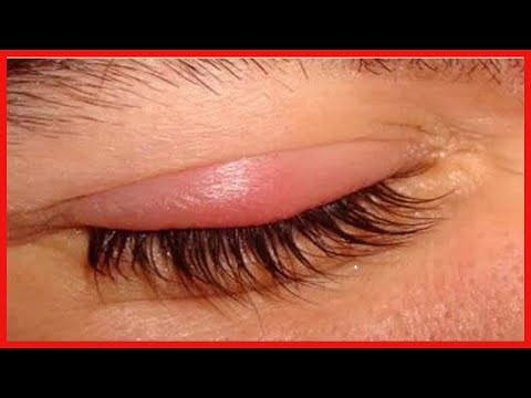 眼瞼炎：原因、症状、治療法