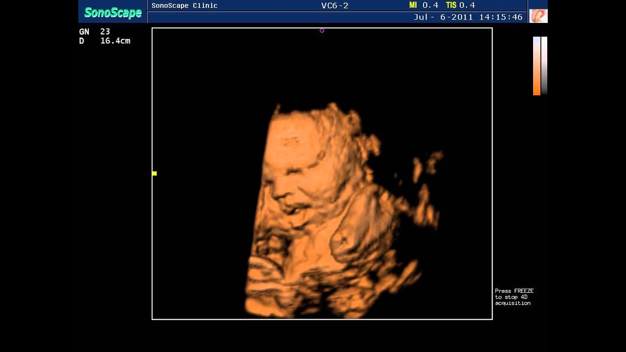 Doppler sonography