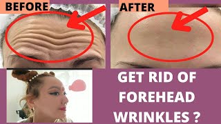 GET Rid of FOREHEAD WRINKLES? Wrinkles between the Eyebrows | Facial Cupping How To Get Rid Of Forehead Wrinkles Reduce Wrinkles Between The Eyebrows Facial Cuping