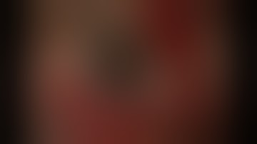 Aphakia Solved, Gore-Tex pre-threaded Micropure 1.2.3 IOL with 4-point fixation Dr. Mauricio Pérez