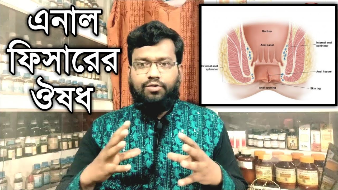 এনাল ফিসারের হোমিও চিকিৎসা ঔষধ | মলদ্বারে জ্বালাপোড়া ব্যাথা | AnalFissure homeopathic