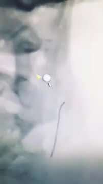 KOLESTEROL NEDEN YÜKSELİR?