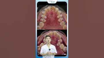 Cách Bác Sĩ Nong Rộng Cung Hàm Khi Niềng Răng | Nha Khoa Minh Châu