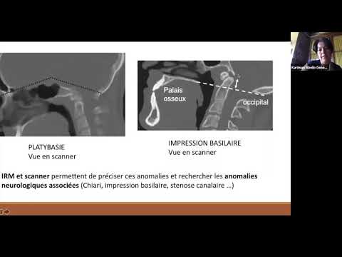 7. Malformations squelettiques dans la délétion 22q11 par le Dr Kariman Abelin Genevois