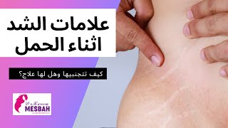 stretch marks علامات الشد أثناء الحمل