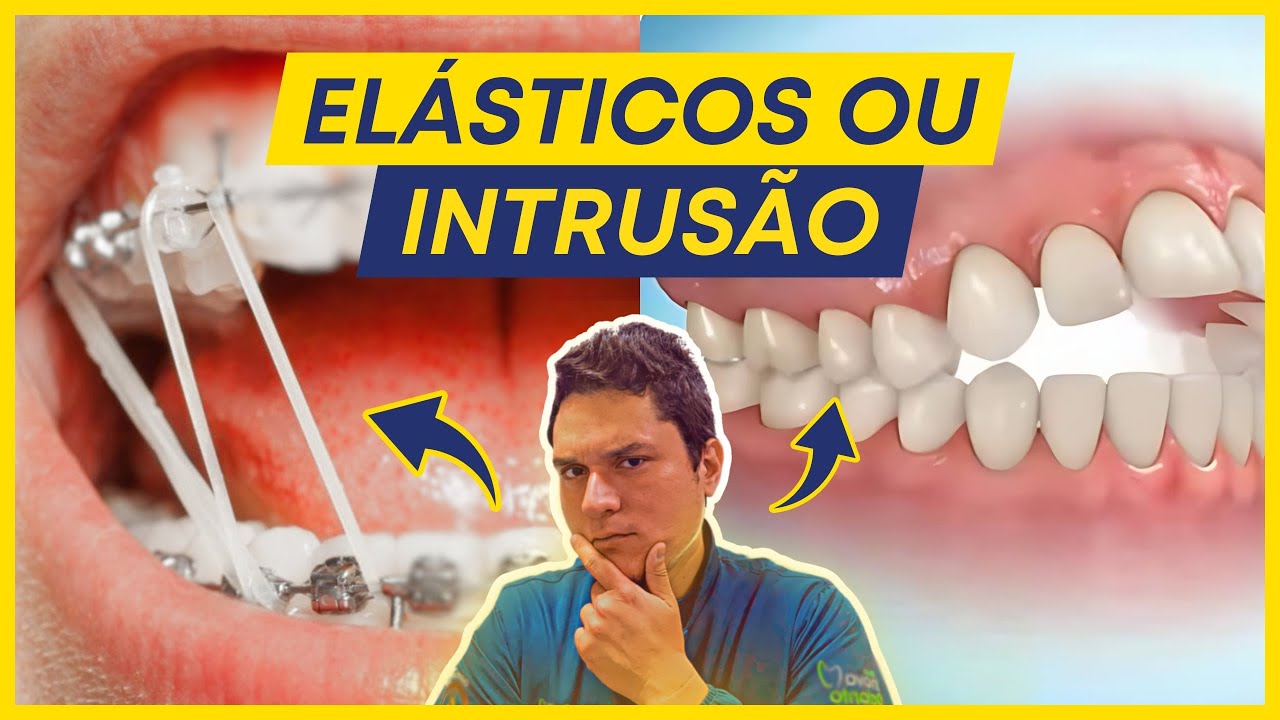 COMO CORRIGIR A MORDIDA ABERTA : ELÁSTICOS OU INTRUSÃO POSTERIOR?