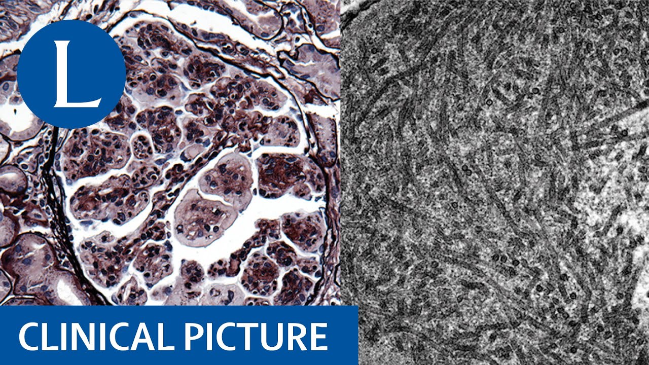 Clinical Picture Immunotactoid Glomerulopathy Associated With 