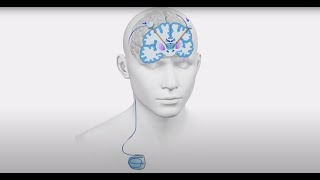 Deep Brain Stimulation (DBS) for Parkinson’s Disease, Essential Tremor, and Epilepsy