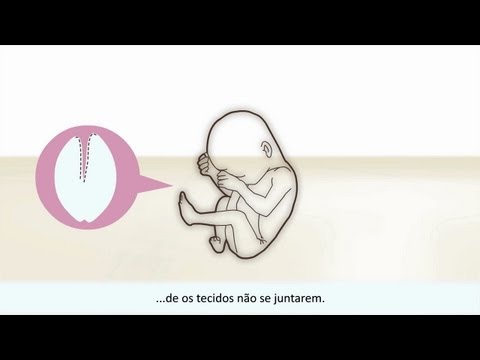 Fissura Labiopalatal - Causa e tratamento