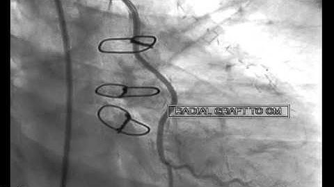 Radial artery graft in Coronary bypass surgery ,ten year patency.