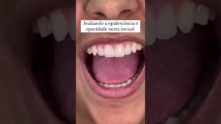 Opal e Opaco na mesma incisal