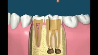 Root canal treatment animation