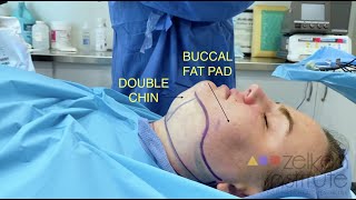 WOW! FACIAL CONTOURING surgery (buccal fat pad removal and submental liposuction) by Dr. Zelken
