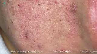 Big Cystic Acne Blackheads Extraction Blackheads & Milia, Whiteheads Removal Pimple Popping