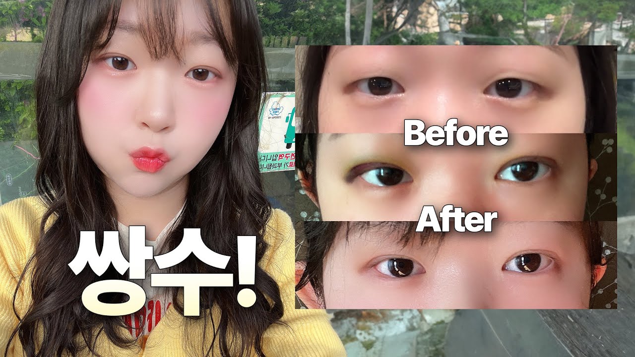 자연유착+눈매교정 쌍수후기🔥 피멍 어떻게..?😨ㅣ쌍수 전날~3일차까지 100% 리얼후기📝ㅣ수면마취 썰, 붓기관리, 붓기 빠지는 약, 냉찜질, 멍, 병원고르는법, 식단시작? ep1