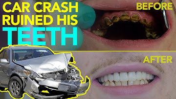 Teeth Knocked out in Car Accident - Restoration Needed - Most Natural Looking and Feeling Options