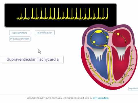 www.richacls.com A narrated and animated review of Supraventricular Tachycardia, Atrial Fibrillation and Atrial Flutter. To learn more about ECG Rhythms and ACLS class preparation visit our website! www.richacls.com