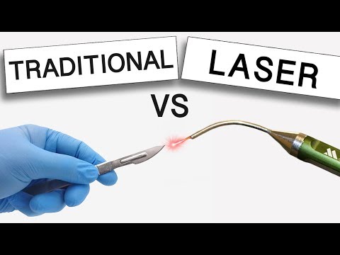 Video: Periodontal Behandling: Kostnad, Laser, Faser, Alternativer Og Mer