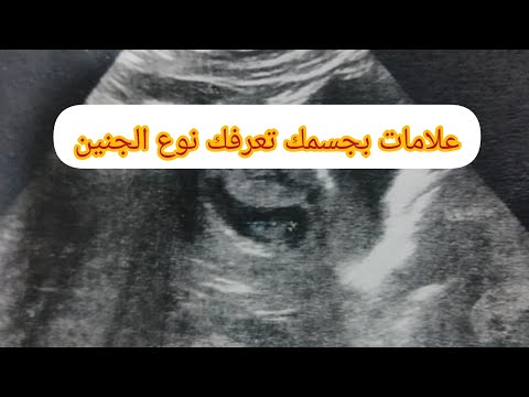 حمل بولد عن تجربه علامات واضحه جدا من أول شهر تعرفك نوع الجنين