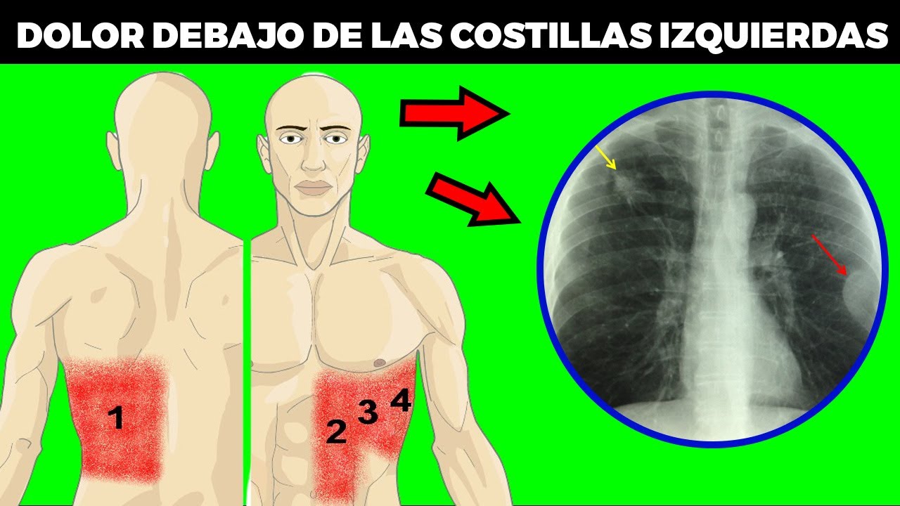DOLOR DEBAJO de las COSTILLAS del LADO IZQUIERDO: causas, tratamiento y  cuando acudir al médico - YouTube