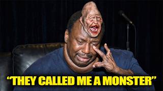 Famous 21 Black Celebrities Who Had Deformed Bodies That Shocked America Wealth