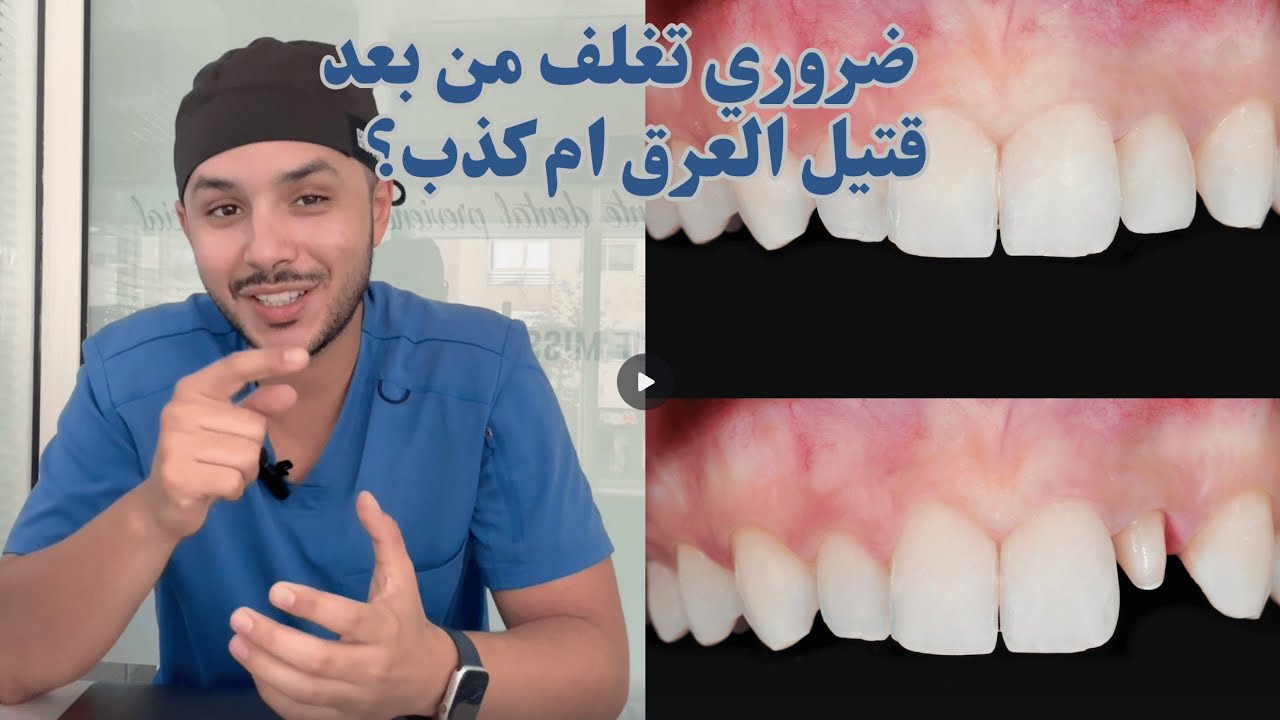 وش ضروري تغلف من بعد قتيل العرق ام كذب؟