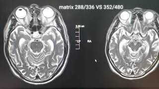 Mri Matrix Sizepixel Image Comparison According To Pixel Size