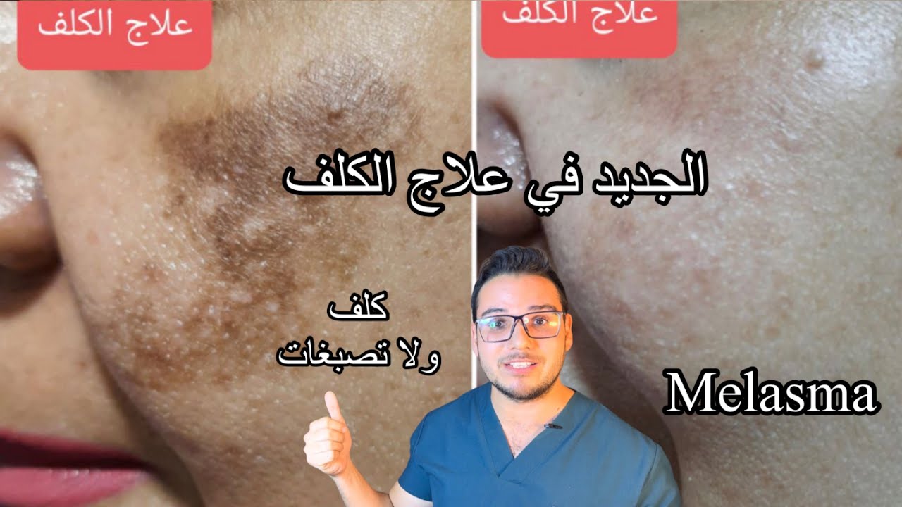 كلف ولا تصبغات  ؟؟ ايه الجديد في علاج الكلف ؟ دي نتيجه شهر واحد فقط