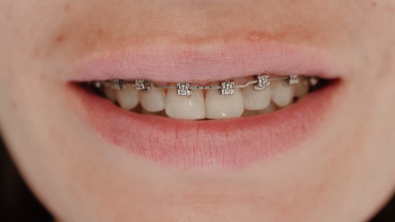 Facing the Future Orthodontics | After-Hours Care | Damon Treatment