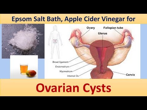 natural-remedies-for-ovarian-cysts---epsom-salt-bath,-apple-cider-vinegar