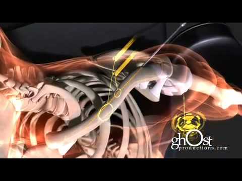 Medical Animation - Heal: ghOst Production's 2009 ...