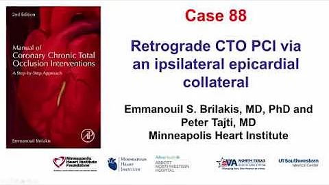 Case 88: Manual of CTO Interventions: Retrograde via ipsilateral epicardial collateral