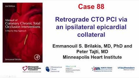Case 88: Manual of CTO Interventions: Retrograde via ipsilateral epicardial collateral
