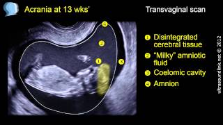 Acrania: Five different presentations