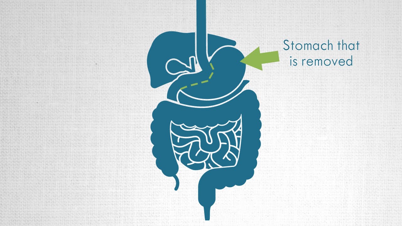 Vertical sleeve gastrectomy at Prevea Health