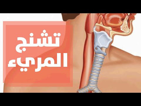 فيديو: هل تشنجات المريء خطيرة؟