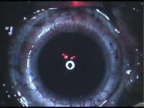 Video: Kompenzace Presbyopie Rohovky: PresbyLASIK: Aktualizovaná Recenze