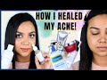 HOW TO MINIMISE ACNE SPOTS in 2 weeks | Saturn by Good Health Company AFFORDABLE Indian skincare