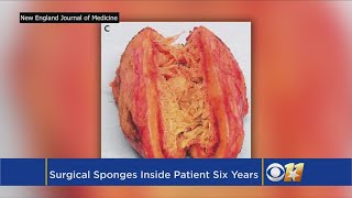 Doctors Find Surgical Sponges Left In Woman For At Least 6 Years screenshot 5